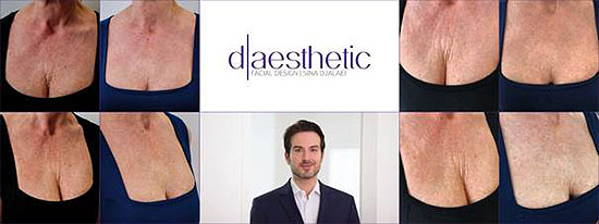 "d-aesthetic" - Nicht nur zur Oktoberfest- und Dirndl-Zeit: Ein faltenfreies, schönes Dekolleté... ... in jedem Alter – ohne OP  (©Foto: d-aesthetic)